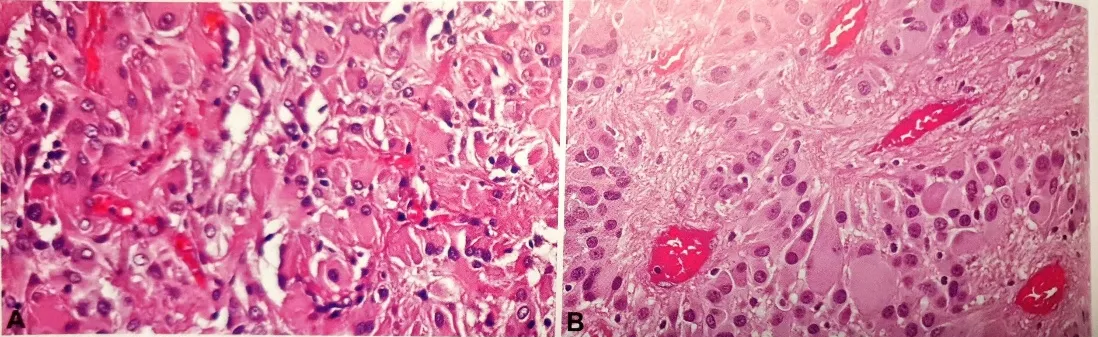 L A Mixed population Of polygonal to ganglionic-like cells. B Collection of large tumour cells, with perivascular 