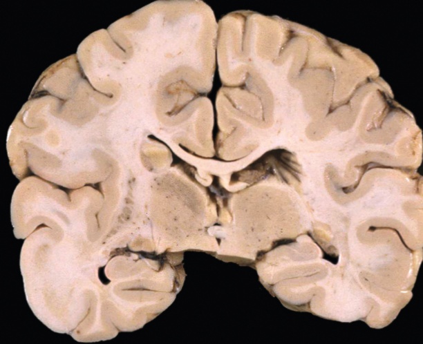 A close-up of a brain AI-generated content may be incorrect.