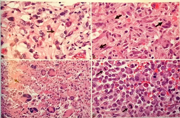 Fig. 2.26 Anaplastic pleomorphic xanthoastrocytoma. A The tumour shows classic features with pleomorphic and xanthomatous (arrow) cells and (B) brisk mitotic activity (arrows). including atypical mitoses. C The tumour recurred 1 year later and showed remaining areas with pleomorphic morphology and (D) monomorphous areas with epithelioid and rhabdoic cells with mitotic activity (arrows). 