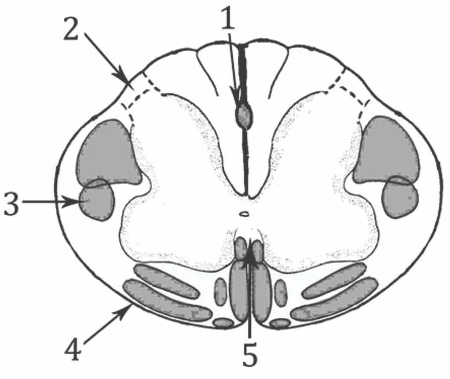 (1) midline pain pathway (2) Dorsal root entry zone (3) corticospinal tract (4) anterolateral spinothalamic tract (5) ventral white decussation)