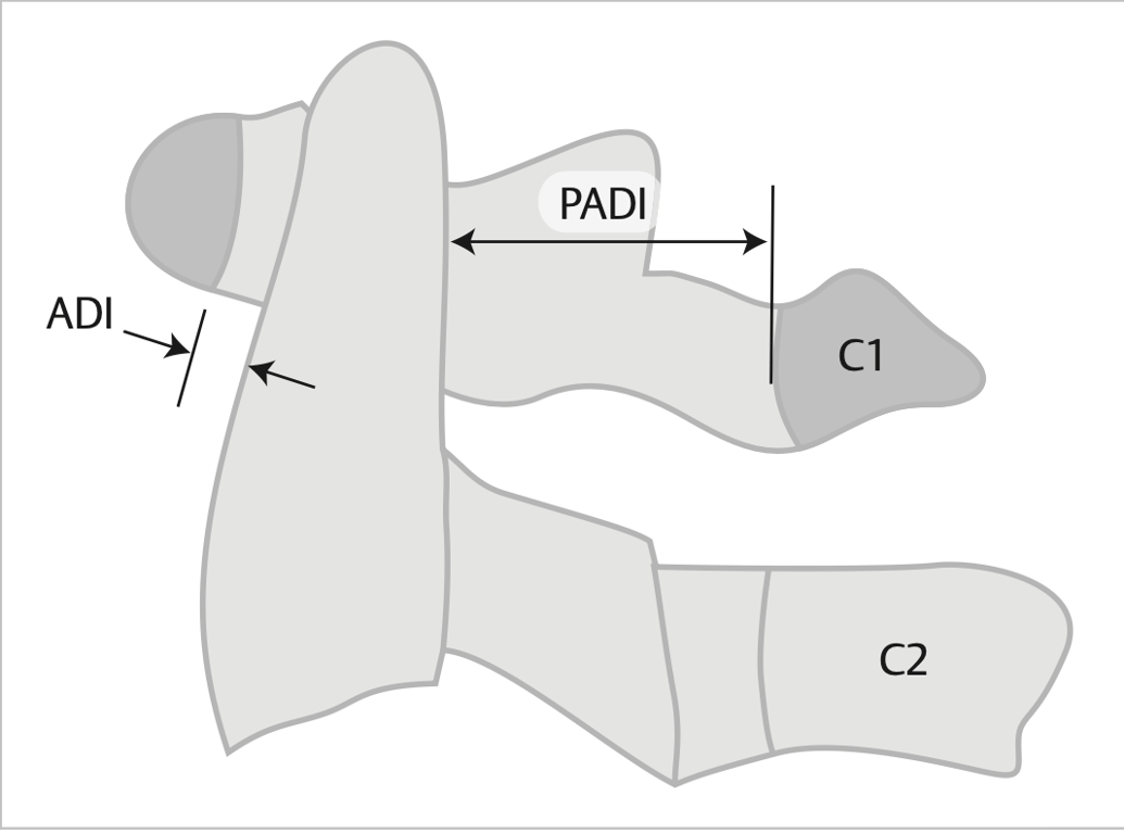 Measure ADI: distance between anterior margin of dens and closest point of anterior arch of C1 (normal 2-4mm) and PADI (neural canal width): back of odontoid to anterior aspect of posterior C1 ring.