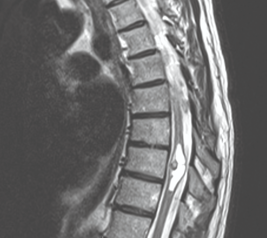 Thoracic hemangio-blastoma demonstrating enhancing mural nodule w/ cyst