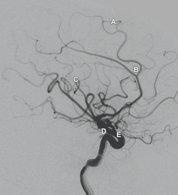 (A) Distal callosomarginal artery (B) ACA bifurcating into pericallosal artery and callosomarginal artery (transition of A2 to A3). Other branches include (C) MCA (D) supraclinoid ICA (E) origin of opthalmic artery