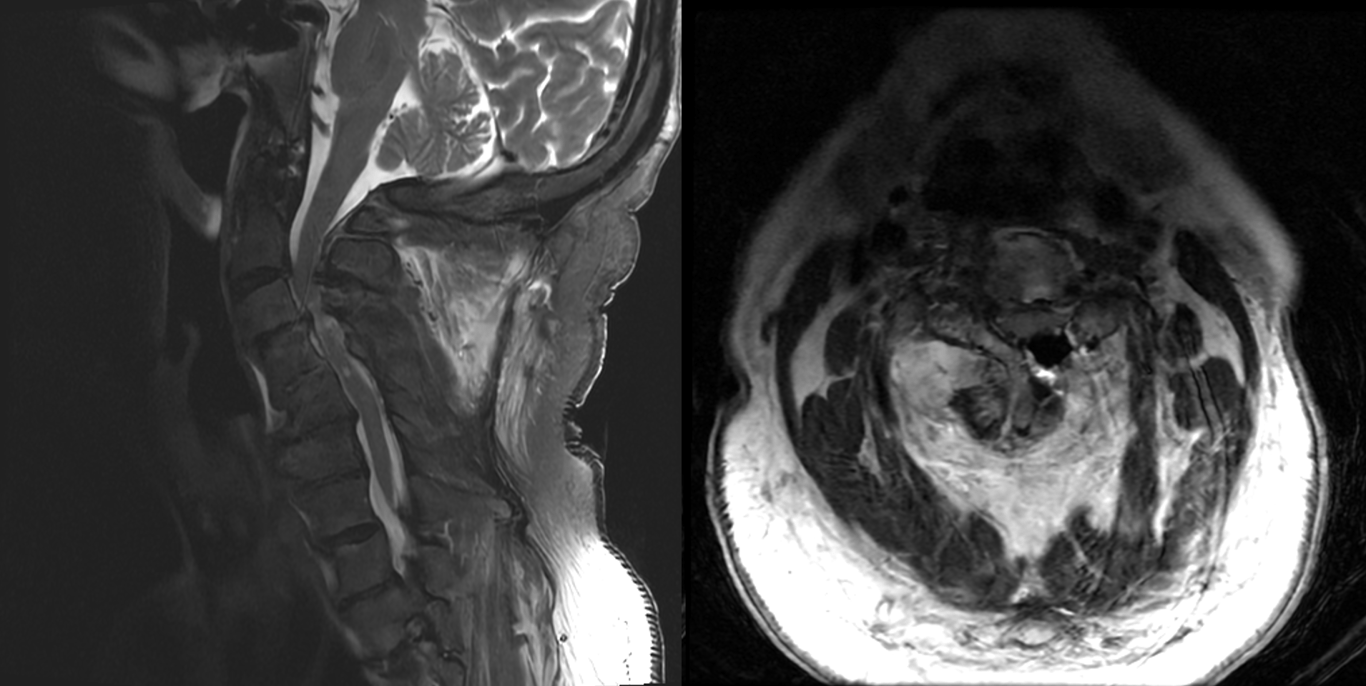 Figure 3: T2 sagittal (left) and axial (right) demonstrating multi-level cervical stenosis worse at C3-4 (left)