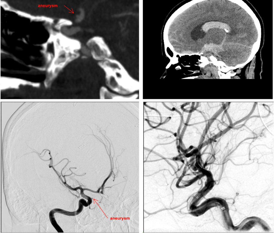 (top-left) CTA showing ventral anteriorly projecting tiny blister aneurysm causing a devastatingly large aneurysmal bleed w/ IVH (top-right) re-demonstrated on angiography (bottom left) and simultaneously treated with a flow diverter (bottom right)