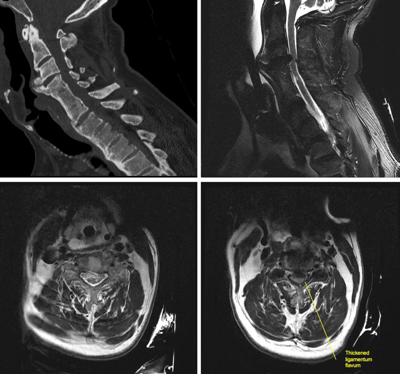 (Top left) CT C-spine demonstrating no acute fx but a large C3-4 DOC (top right, bottom left) MRI T2 images showing severe spinal cord compression w/ a focal area of L myelomalacia (T2 hyperintensity) below the level of DOC. (bottom right) severe spinal cord stenosis at level of DOC (C3-4) 2/2 thickened ligamentum flavum posteriorly and DOC anteriorly.