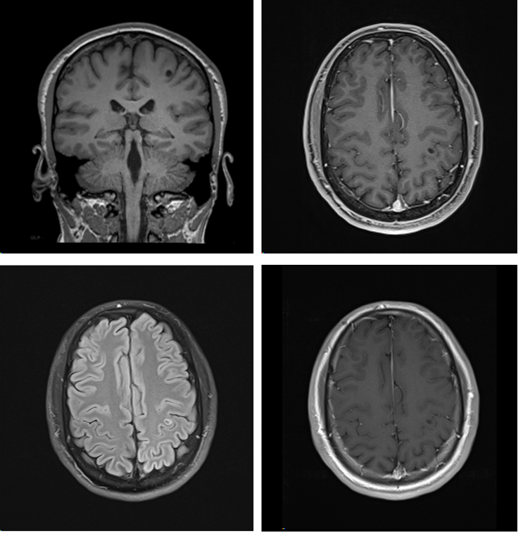 Coronal and axial T1 images showing hypo-dense left hand-knob lesion (top) with no edema on T2 FLAIR (bottom lef) nor enhancing (bottom right) 