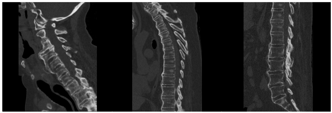 extensive auto-fusion of the entire spine in an elderly male with back pain.