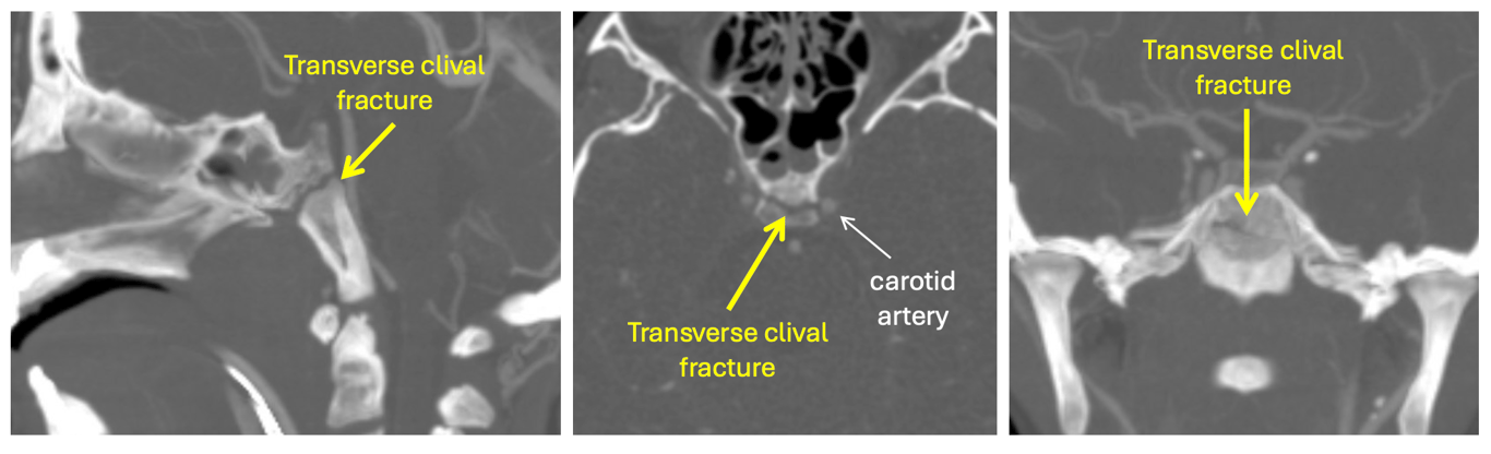 CT angiography of the head in sagittal (left), axial (center), coronal (right) planes demonstrating transverse clivus fracture involving bilateral carotid canals.