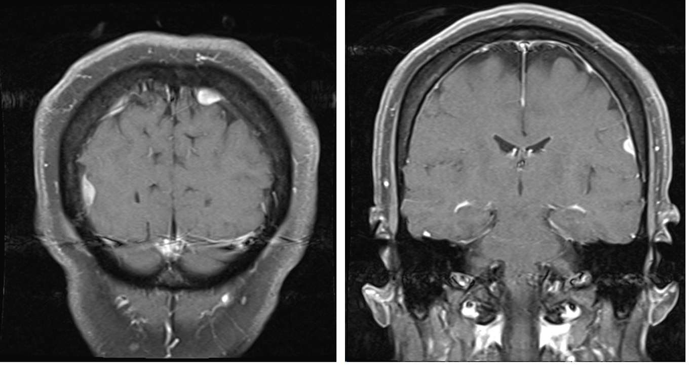 middle aged female with hx autoimmune comorbidities who presented with headaches, vision changes (found to have anterior uveitis) found to have 5 total dural-based lesions on MRI T1+c. 