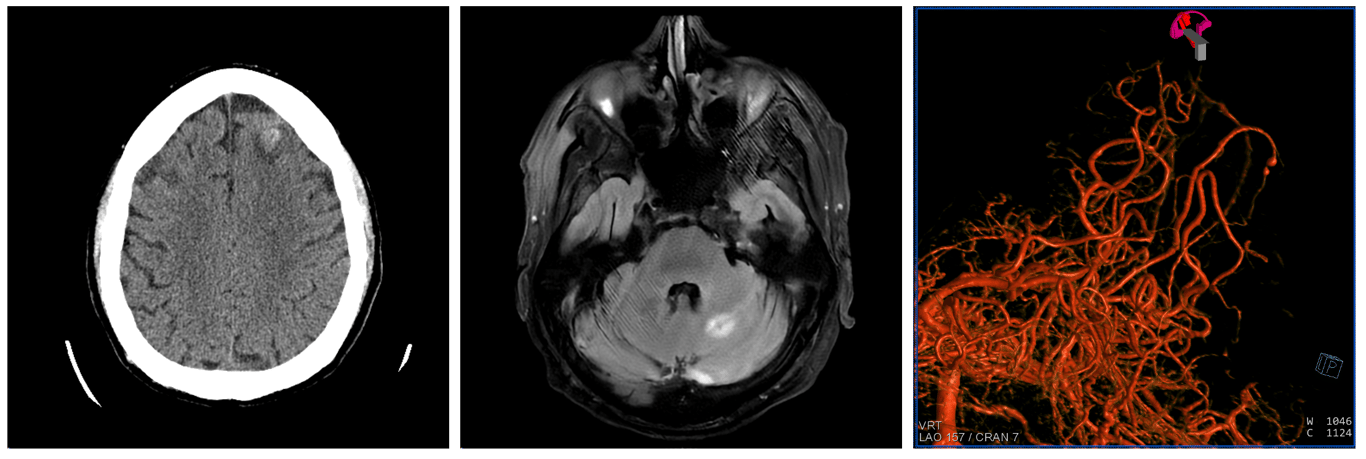 A middle aged bacteremic male was found to have L frontal SAH on CTH non-con (left) along with scattered hemorrhages on MRI (middle) including L cerebellar, ultimately only found to have a distal Right PCA mycotic aneurysm (right)