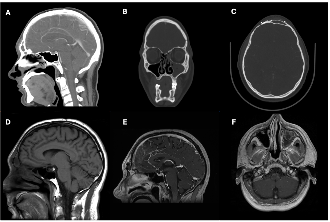 (A): CT with contrast showing moderate-severe dependent swelling in the forehead on presentation (B): complete opacification of L maxillary sinus is seen, consistent with severe sinusitis (C): completely opacified surgical post-surgical frontal sinus on the left. T1 without contrast (D) and T1 with contrast (E) demonstrating enhancement of frontal scalp and adjacent dura consistent with cellulitis +/- focal meningitis. (F) re-demonstration of severe maxillary sinusitis on left side.