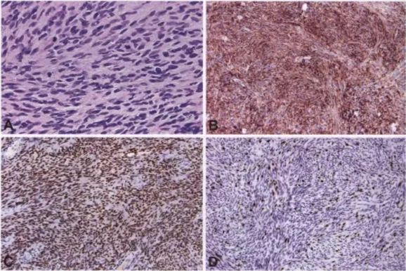 Fig. 9.07 Cellular schwannoma composed entirely of compact Antoni A tissue, but with other common features of conventional schwannoma, such as hyalinized blood vessels. Fig. 9.08 Cellular schwannoma. A An increased mitotic index is often seen in cellular schwannoma and should not be taken as evidence of malignant peripheral nerve sheath tumour (MPNST) when other classic features of schwannoma are also found. B Diffuse expression of SIOO protein helps to distinguish cellular schwannoma from MPNST. C Extensive nuclear positivity for SOXIO helps distinguish this cellular schwannoma from MPNST. D A moderate Ki-67 proliferation index is not uncommon in cellular schwannoma, but the proliferation index is usually still lower than that encountered in most MPNSTs. 
