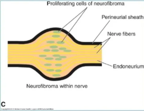 Schwannoma within nerve Schwannoma Perineurial sheath Endoneurium Nerve fibers c Proliferating cells of neurofibroma Perineurial sheath Nerve fibers Endoneurium Neurofibroma within nerve Difference between Neurofibroma & Schwannoma Definition Schwannoma CAN be separated from nerve fascicles & Neurofibroma cannot (as it is interwinned within nerve fibers in the endoneurium). 