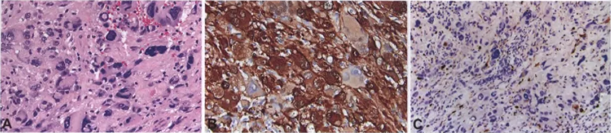 Ancient schwannoma. A Marked degenerative atypia may induce concem expression. C The markedly atypical tumour cells are negative for Ki-67, providing further support that they are degenerative in nature. Fig. 9.06 for malignant transformation, but other features of malignancy are lacking. B Diffuse SIOO 
