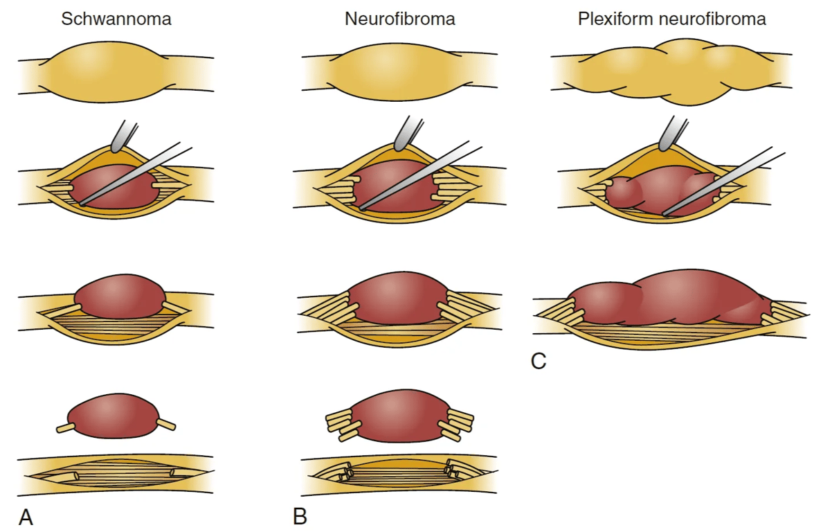 Schwannoma Neurofibroma Plexiform neurofibroma c FIGURE 203-5 Schematic illustration of surgery for benign peripheral nerve sheath tumors. A, Schwannoma resection. The tumor causes well- circumscribed dilatation of the nerve. Internal neurolysis shows that the tumor has thinned and displaced the fascicles. A single small fascicle may be enveloped by tumor. The fascicles surrounding the schwannoma are dissected free, the tumor capsule is opened, and the schwannoma, and any enveloped fascicles, are resected en bloc. B, Neurofibroma resection. Neurofibromas cause well-circumscribed nerve dilatation (similar to schwanno- mas). However, unlike schwannomas, neurofibromas envelop, rather than displace, the majority of fascicles. After internal neurolysis, the tumor is seen enveloping multiple nerve fascicles. The neurofibroma and enveloped fascicles are resected en bloc. Nerve grafts may be required to repair functional fascicles that were resected. C, Plexiform neurofibroma debulking. The plexiform neurofibroma has caused fusiform dilatation of the affected nerve. Intraneurally, the tumor has enveloped many fascicles. The tumor is debulked, but it cannot be fully resected. 