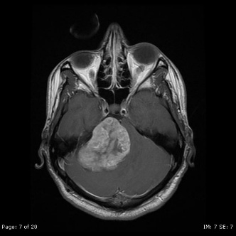 A mri of a brain AI-generated content may be incorrect.