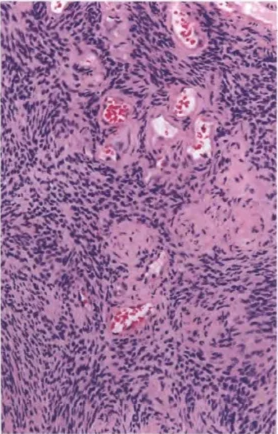 Fig. 9.07 Cellular schwannoma composed entirely of compact Antoni A tissue, but with other common features of conventional schwannoma, such as hyalinized blood vessels. Fig. 9.08 Cellular schwannoma. A An increased mitotic index is often seen in cellular schwannoma and should not be taken as evidence of malignant peripheral nerve sheath tumour (MPNST) when other classic features of schwannoma are also found. B Diffuse expression of SIOO protein helps to distinguish cellular schwannoma from MPNST. C Extensive nuclear positivity for SOXIO helps distinguish this cellular schwannoma from MPNST. D A moderate Ki-67 proliferation index is not uncommon in cellular schwannoma, but the proliferation index is usually still lower than that encountered in most MPNSTs. 