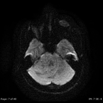 A close-up of a scan of a brain AI-generated content may be incorrect.