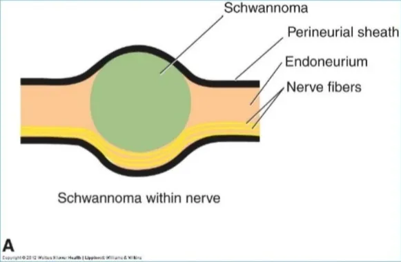 Schwannoma within nerve Schwannoma Perineurial sheath Endoneurium Nerve fibers c Proliferating cells of neurofibroma Perineurial sheath Nerve fibers Endoneurium Neurofibroma within nerve Difference between Neurofibroma & Schwannoma Definition Schwannoma CAN be separated from nerve fascicles & Neurofibroma cannot (as it is interwinned within nerve fibers in the endoneurium). 