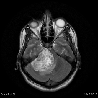 A mri of the brain AI-generated content may be incorrect.