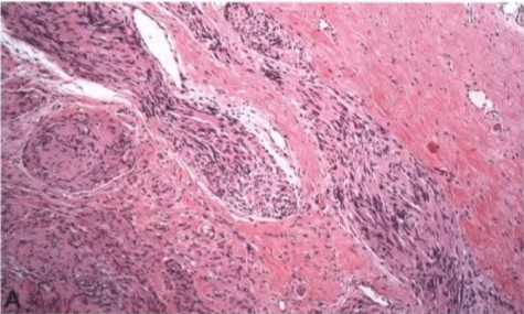 9.09 Plexiform schwannoma.A Multi le I • ' 