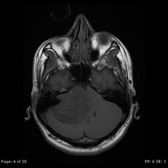 A close-up of a mri scan AI-generated content may be incorrect.
