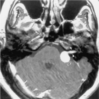 FIGURE 3-9. Cerebellopontine angle and intracanalicular vestibular ¯schwannoma. Note the brightly enhancing mass with both a cisternal (open arrow) and intracanalicular (arrowheads) portion. The ipsilateral pre- pontine cistern is enlarged. 