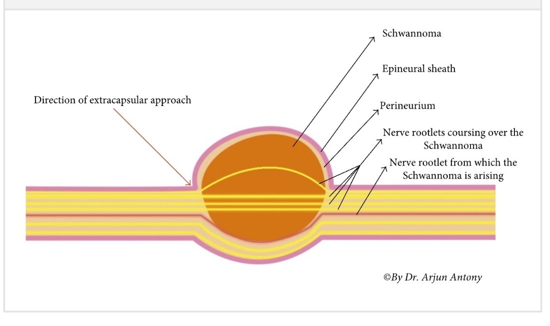 Direction of extracapsular approach Schwannoma Epineural sheath Perineurium Nerve rootlets coursing over the Schwannoma Nerve rootlet from which the Schwannoma is arising OBy Dr. Arjun Antony 