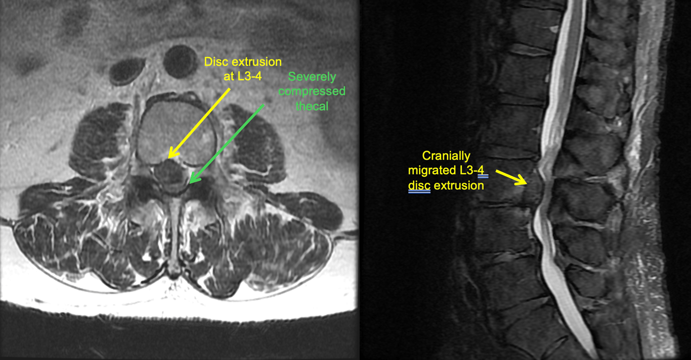 A 65 year old male who presented with R LBP radiating to buttock with subjective leg weakness showing a Right eccentric L3-4 disc extrusion causing severe compression of thecal sac. 