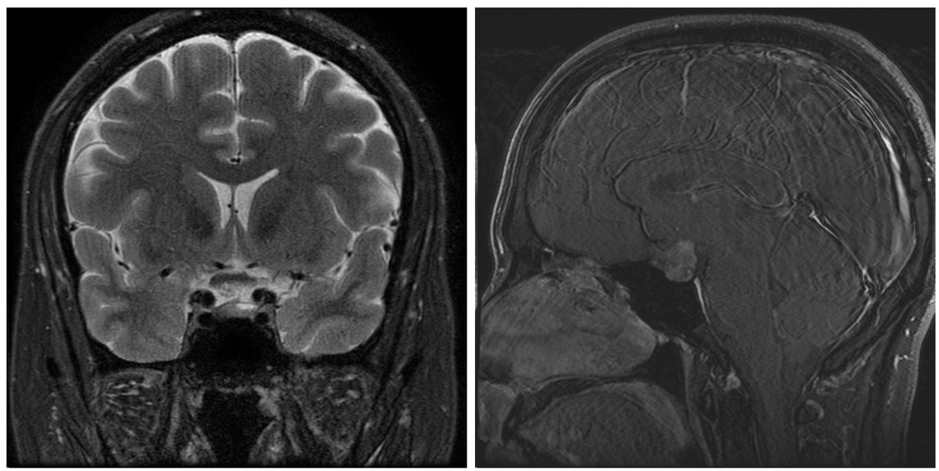 Middle aged male with a medically refractory prolactinoma underwent EEA of a heterogenosly enhancing mass on T1+c (RIGHT) with inferior chiasmal abutment on T2 sequencing (LEFT)