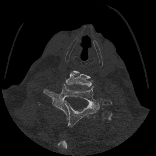 CT axial: L C7 TP fracture
