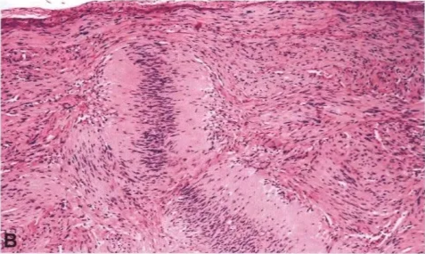 9.09 Plexiform schwannoma.A Multi le I • ' 
