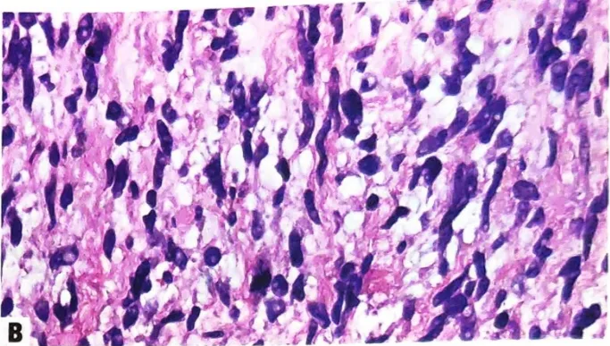 ANNUBP with increased cellularity and mitotic activity, but otherwise falling short of a malignant diagnosis.