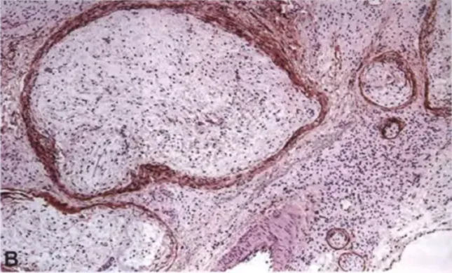 Fig. 9.14 Plexiform neurofibroma. A Multinodular pattern from involvement of multiple fascicles. Note the associated diffuse neurofibroma in the background, with pseudo-Meissner corpuscles (upper left). B EMA immunostaining highlights the perineurium surrounding multiple involved fascicles, whereas the tumour cells are mostly negative. 