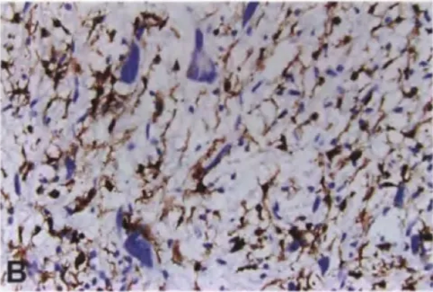 Fig. 9.16 Atypical neurofibroma. A Retained SOXIO expression in cytologicalA atypical nuclei. B Loss of expression of CDKN2A (p16) in cytologicalA atypical nuclei, possibly representing a premalignant change. 
