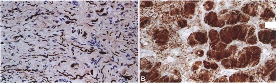 Fig. 9.15 Neurofibroma. A Strong, but patchy SIOO positivity is seen, the stain generally labelling a smaller proportion of cells than in schwannoma. B In pseudo-Meissner corpuscles, SIOO staining is diffuse. 