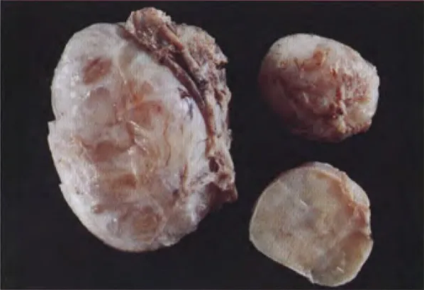 Fig. 9.13 Neurofibroma of a spinal root, with a firm consistency and homogeneous cut surface. 