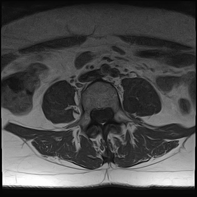 A close-up of an x-ray of a pelvis AI-generated content may be incorrect.