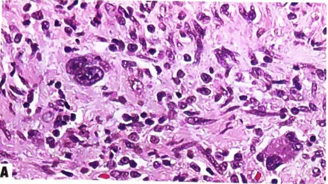 Tumours designated as ANNUBP in patients with neurofibromatosis type 1 may have several worrisome features, including cytological atypia. 