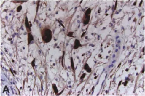 Fig. 9.16 Atypical neurofibroma. A Retained SOXIO expression in cytologicalA atypical nuclei. B Loss of expression of CDKN2A (p16) in cytologicalA atypical nuclei, possibly representing a premalignant change. 