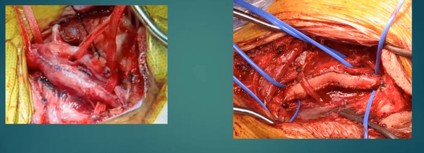 (LEFT) primary closure. (RIGHT) patch angioplasty. note that this increases diamater at level of stenosis which may decrease restenosis risk logically however also may increase it by disrupting laminar flow, increasing clotting risk.