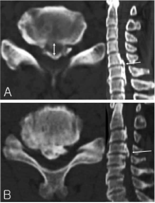 A: The double-layer sign, consisting of anterior and posterior ossified rims separated by a centrally hypertrophied PLL. In the axial view, the double arrow shows the method of measurement of the central hypodense mass, and in the sagittal view the arrow points to the level being demonstrated in the axial view. B: The single-layer sign, consisting of a single homogeneous ossified PLL mass. In the sagittal view, the arrow points to the level being demonstrated in the axial view.