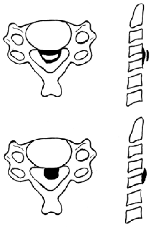 Upper: Double-layer sign, consisting of anterior and posterior ossified rims separated by a centrally hypertrophied PLL.
Lower: Single-layer sign, consisting of a single homogeneous ossified PLL mass.