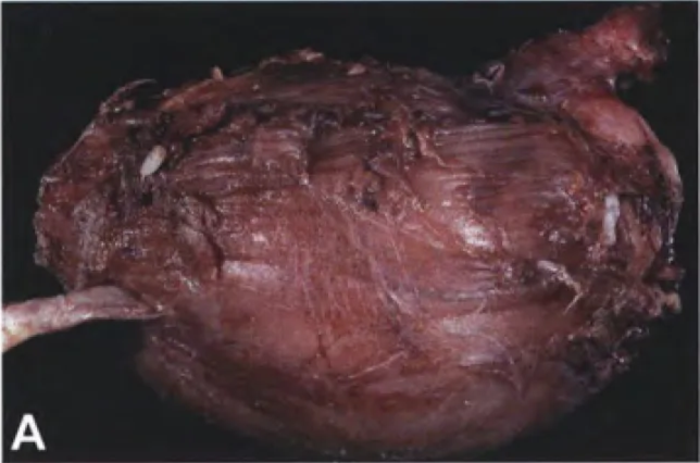 Fig. 9.23 Malignant peripheral nerve sheath tumour (MPNST). A Resected MPNST with its parent nerve on the left. Note the skeletal muscle that forms part of the surgical margin, indicating invasion into the surrounding soft tissues. B On cut sufface, this tumour shows the classic variegated appearance, with fleshy soft cellular regions alternating with yellow foci of necrosis. 