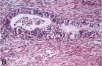 Fig. 9.26 Malignant peripheral nerve sheath tumours with divergent differentiation. A Rhabdomyoblastic differentiation (malignant triton tumour). B Formation of glands. C Focal myogenic differentiation visualized by desmin-positive tumour cells. 