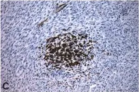 Fig. 9.26 Malignant peripheral nerve sheath tumours with divergent differentiation. A Rhabdomyoblastic differentiation (malignant triton tumour). B Formation of glands. C Focal myogenic differentiation visualized by desmin-positive tumour cells. 