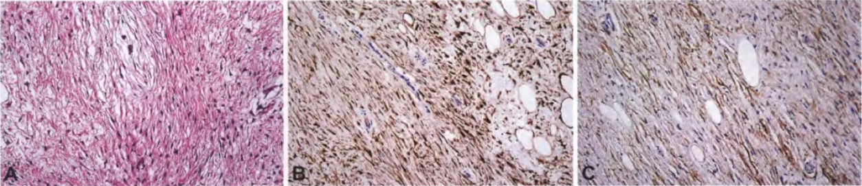 Fig. 9.20 Hybrid schwannoma/perineurioma. A Benign spindle cell nerve sheath tumour with loose myxoid stroma that is difficult to classify on H&E alone. B SIOO immunostaining highlights about tN0 thirds of the hybrid nerve sheath tumour cells, identifying the Schwann cell component. C EMA staining highlights about one third of the tumour cells, identifying the perineurial component. Fig. 9.21 Hybrid neurofibroma/schwannoma. Schwann cell micronodules. C S100-positive Schwann cell micronodules. 