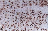 Fig. 9.27 Epithelioid malignant peripheral nerve sheath tumour. A Some tumours B Extensive SIOO positivity. C Marked nuclear immunoreactivity for SOX 10. include rhabdoid cells with eosinophilic paranuclear globular to fibrillar inclusions (arrows). 