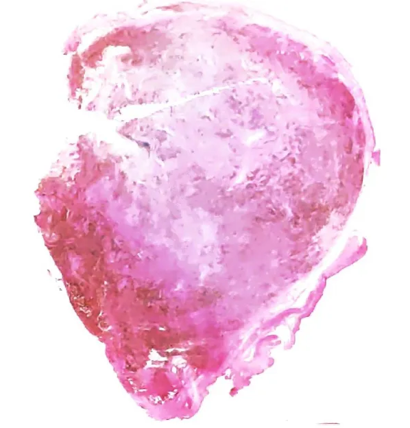 Malignant melanotic nerve sheath tumour. Tumour arising in a spinal nerve root. The tumour is heavily pigmented and partially encapsulated.